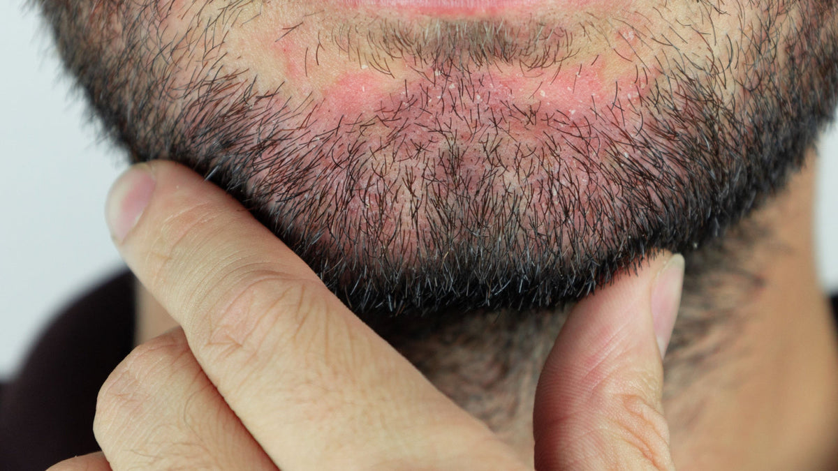 Beard Dandruff Treatment and Care