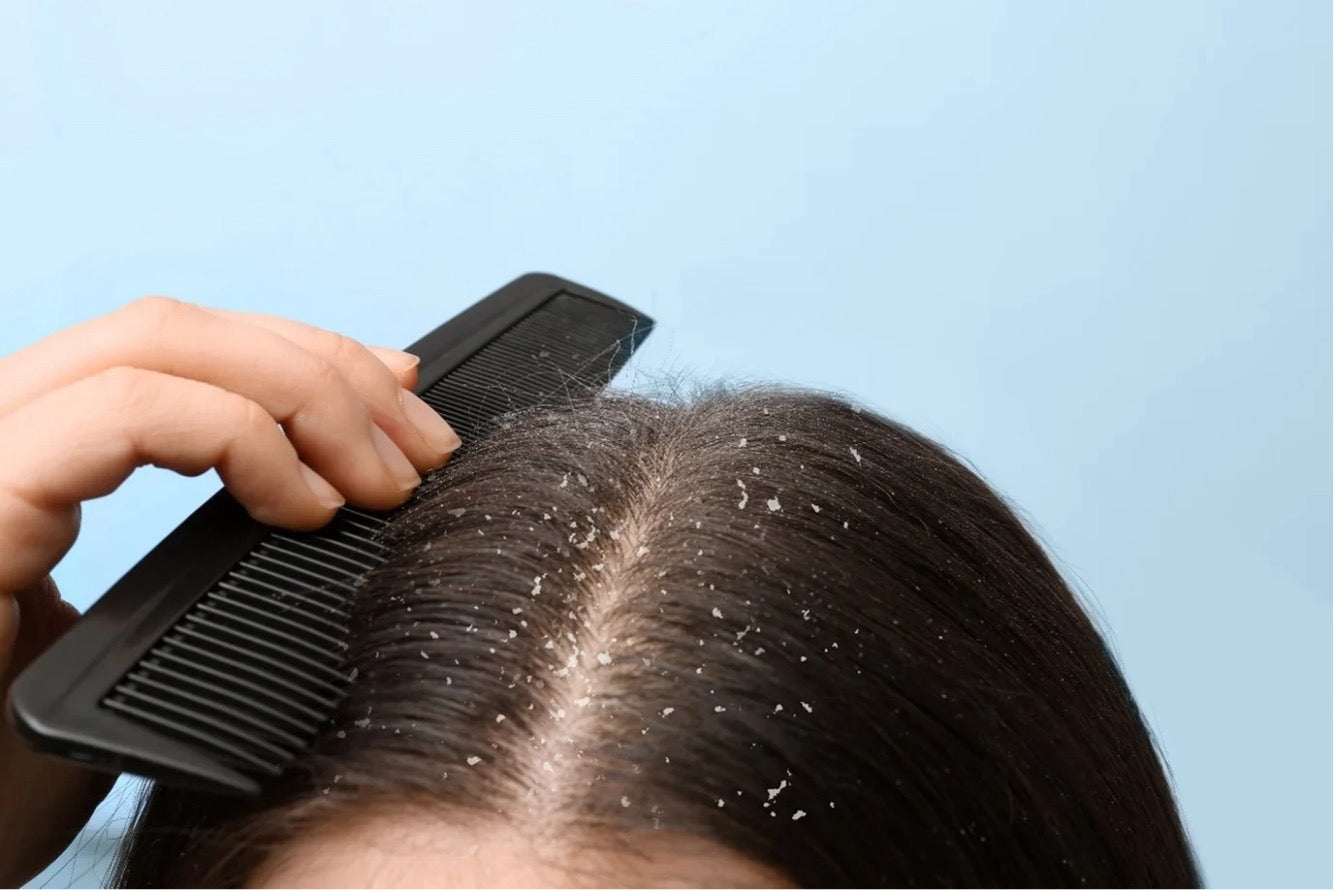 How to Get Rid of Dry Scalp and Restore Moisture Naturally