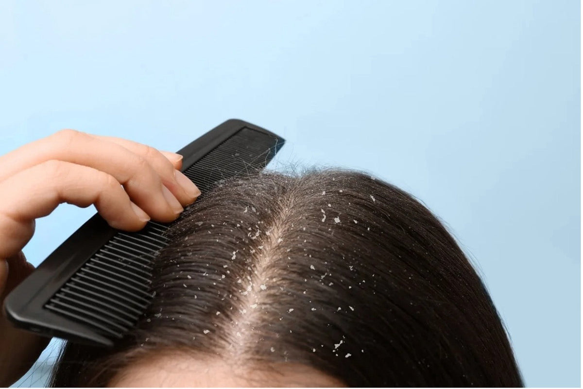 How to Get Rid of Dry Scalp and Restore Moisture Naturally