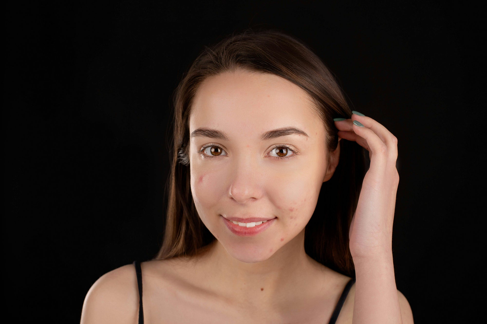 How to Get Rid of Acne Scars Naturally and Effectively with Proven Treatments