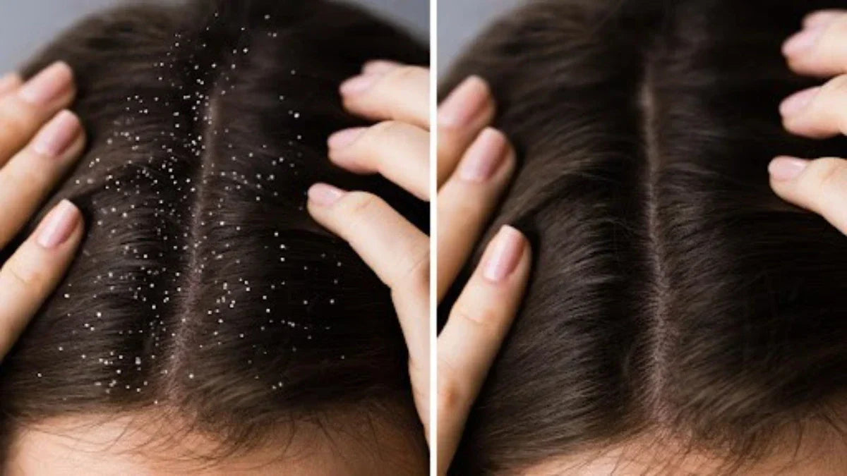 Reset Your Scalp