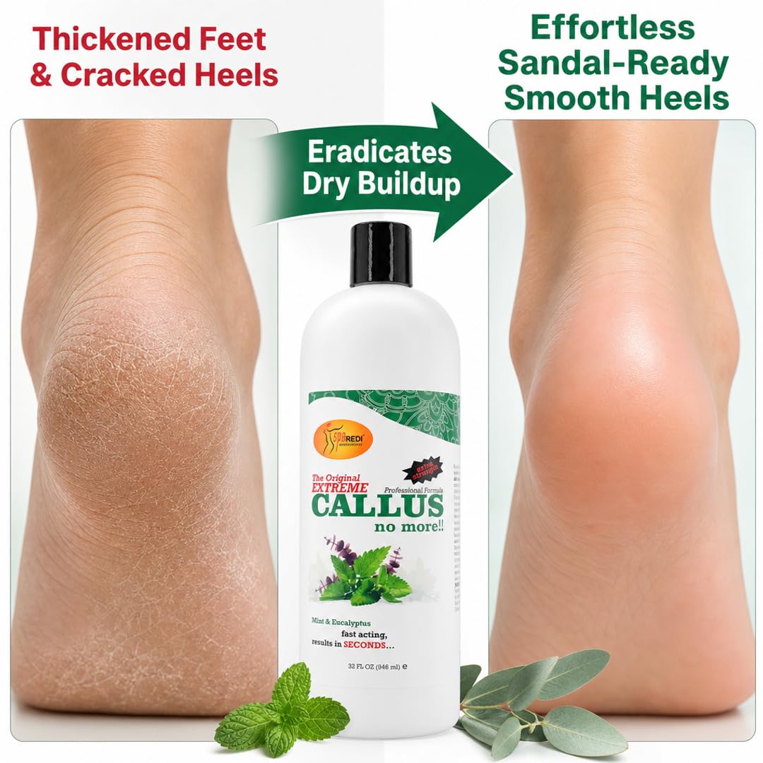 SPA REDI Callus Remover Gel - Quickly Removes Tough Calluses &amp; Smooths Cracked Heels