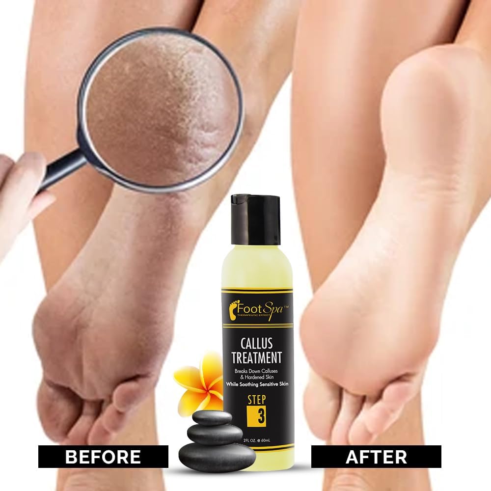 Foot SPA - Callus Remover Gel, 2 Oz - Professional Pedicure Care, Instantly Smooths Dry Cracked Heels &amp; Removes Calluses