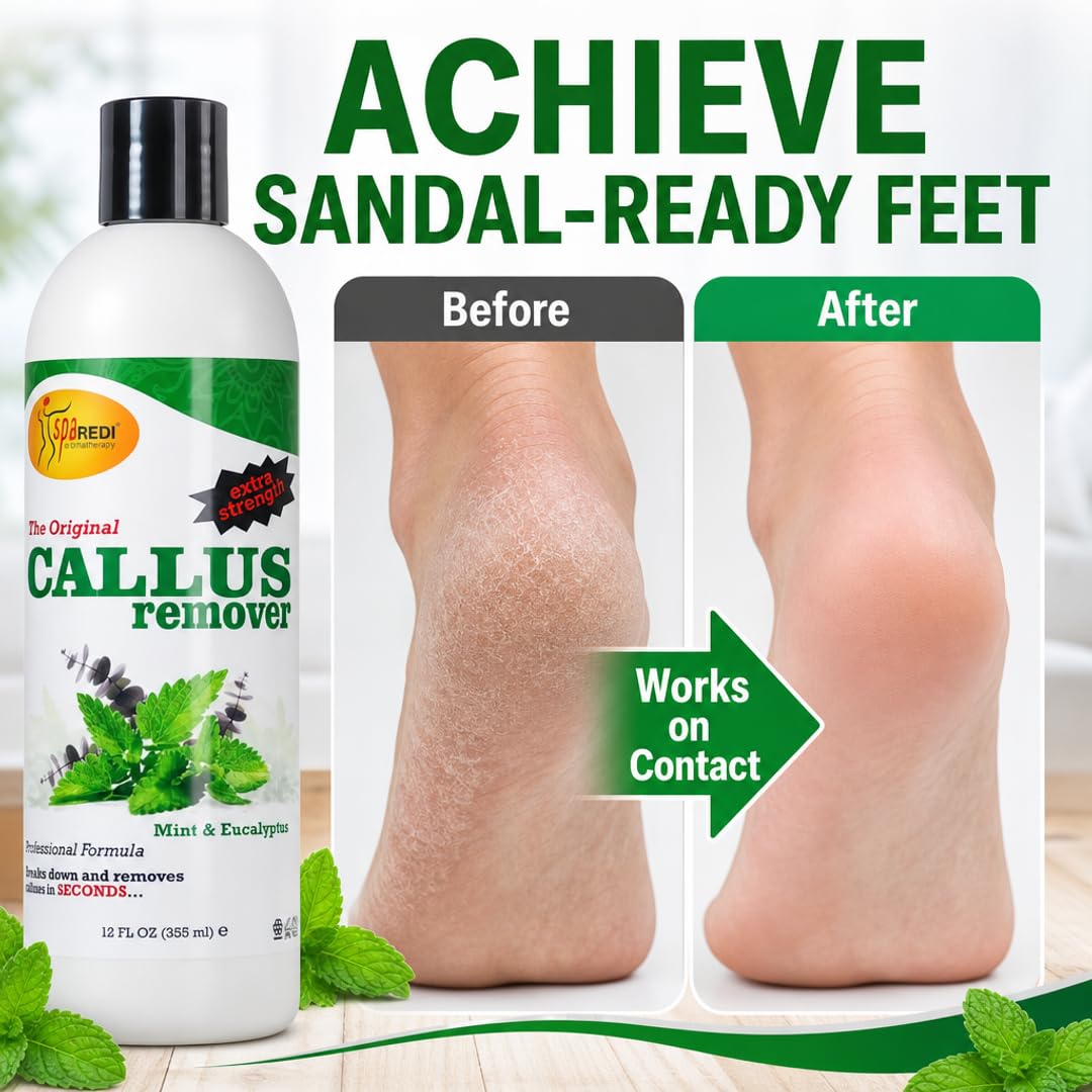 SPA REDI Callus Remover Gel - Quickly Removes Tough Calluses &amp; Smooths Cracked Heels