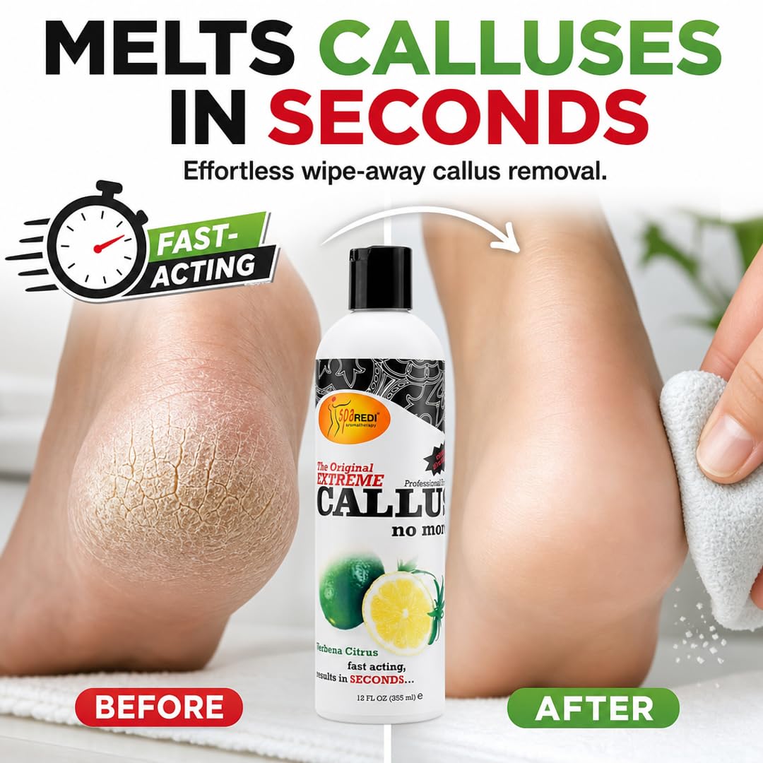 SPA REDI Callus Remover Gel - Quickly Removes Tough Calluses &amp; Smooths Cracked Heels