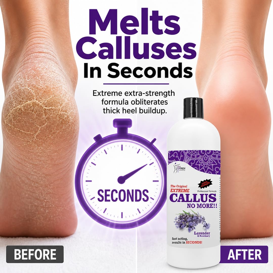 SPA REDI Callus Remover Gel - Quickly Removes Tough Calluses &amp; Smooths Cracked Heels