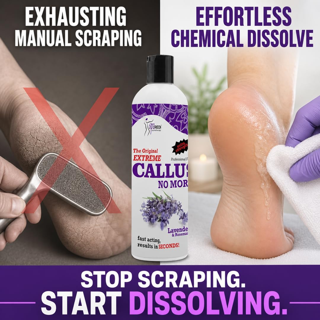 SPA REDI Callus Remover Gel - Quickly Removes Tough Calluses &amp; Smooths Cracked Heels