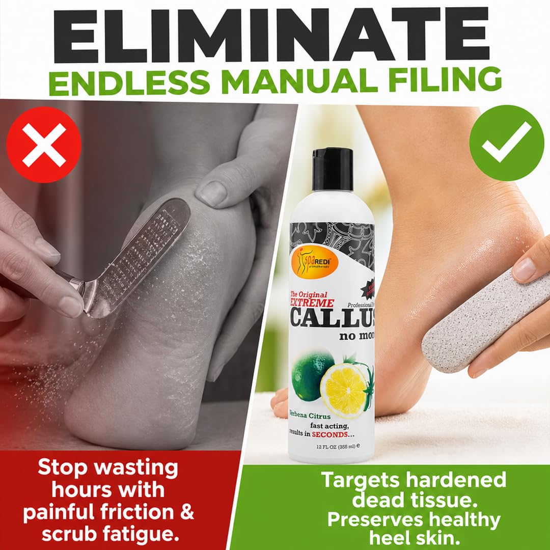 SPA REDI Callus Remover Gel - Quickly Removes Tough Calluses &amp; Smooths Cracked Heels