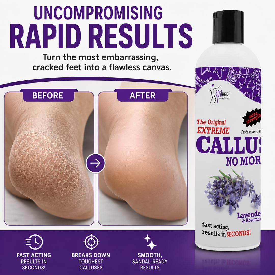 SPA REDI Callus Remover Gel - Quickly Removes Tough Calluses &amp; Smooths Cracked Heels