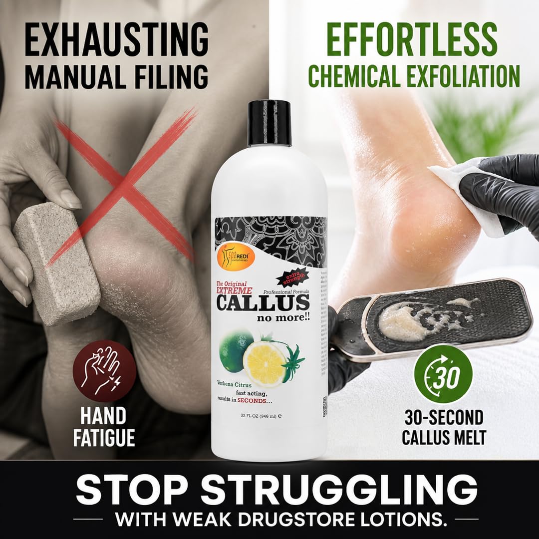 SPA REDI Callus Remover Gel - Quickly Removes Tough Calluses &amp; Smooths Cracked Heels