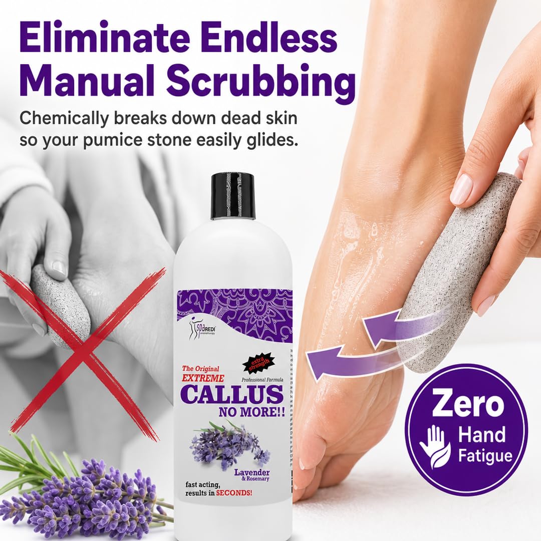 SPA REDI Callus Remover Gel - Quickly Removes Tough Calluses &amp; Smooths Cracked Heels