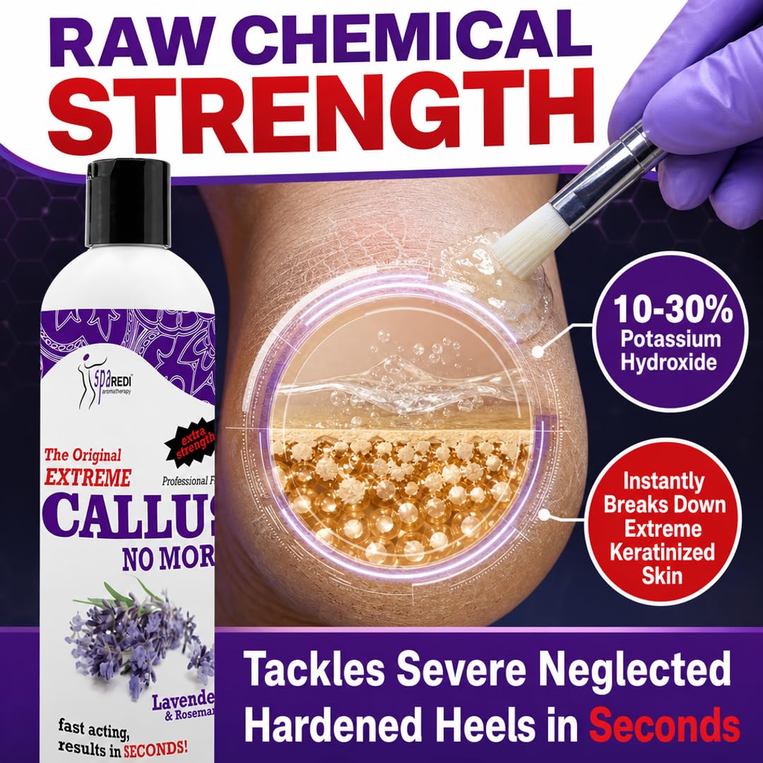 SPA REDI Callus Remover Gel - Quickly Removes Tough Calluses &amp; Smooths Cracked Heels